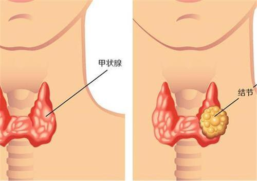 广州中医治疗甲状腺结节效果怎么样