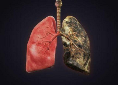 为什么肺癌治疗好之后还会复发?到底什么治疗方法更有优势?