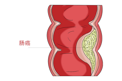 广州中医肿瘤医院|肠道癌早期会有哪些异常表现呢?