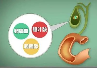 广州中医肿瘤科医师:这些坏习惯会导致胆囊癌,快来看一下