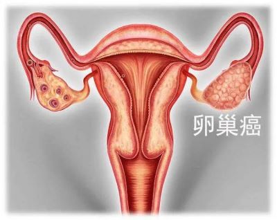 广州中医肿瘤医院排名|卵巢癌的治疗方法有哪些呢