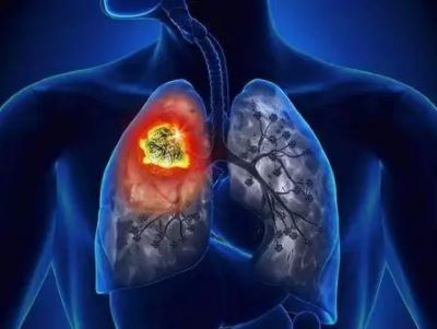 广州中医肿瘤医院排名|肺结核与肺癌如何早期发现呢