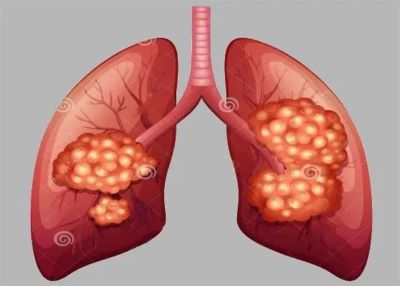 广州治疗肺癌好的老中医:这三种身体报警很有可能是肺癌早期信号