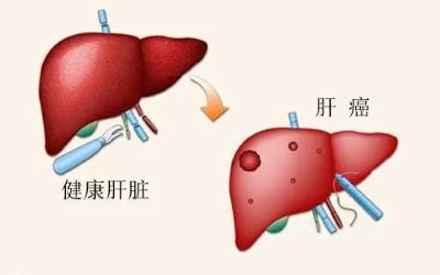 广州中医肿瘤医师排名|带你了解肝癌早期到底有哪些症状