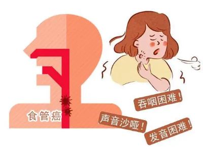 广州治疗食管癌老中医:吃饭经常碰到这个问题很有可能是食管癌