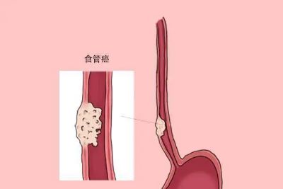 广州中医肿瘤医院排名|不要经常吃过烫的食物,因为会患食管癌