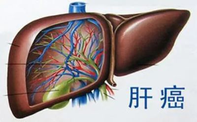 广州肿瘤医师:应该怎样面对癌症呢?肝癌患者应该做些什么