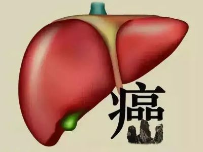 广州中医肿瘤科医院科普|日常想要远离肝病,就要先了解症状