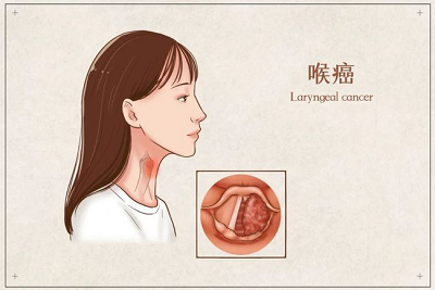 广州看喉癌有效的肿瘤医院是哪