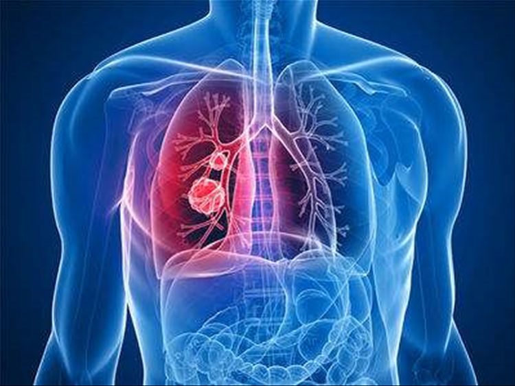 中医是如何治疗肺癌的？看完你就知道了
